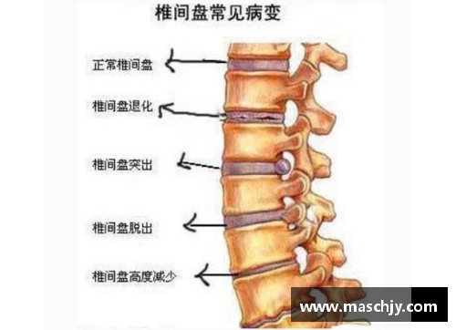 中国体育明星腰间盘突出病症探讨及康复之路分析